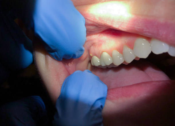 Best Emergency Broken Tooth Repair in Wheeler, TX