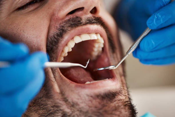 Best Emergency Wisdom Teeth Removal in Wheeler, TX